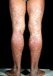 過敏性紫癜綜合徵