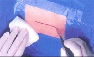 手術薄膜 手術薄膜