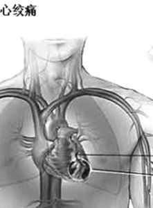 變異性心絞痛