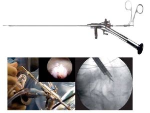 椎間孔鏡手術 椎間孔鏡手術