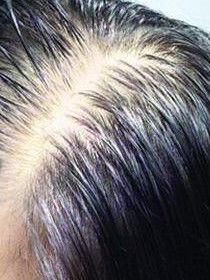 治脂溢性脫髮 治脂溢性脫髮