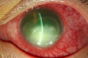 棘阿米巴角膜炎 棘阿米巴角膜炎