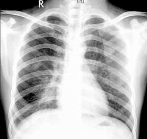 何杰金氏淋巴瘤