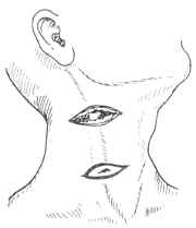 急性化膿性腮腺炎