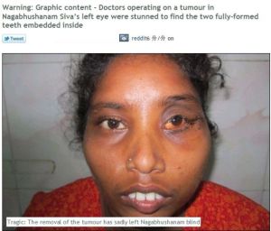 眼眶畸胎瘤 眼眶畸胎瘤