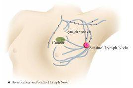 前哨淋巴結 前哨淋巴結