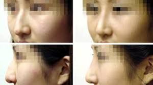 鼻頭鼻翼縮小術