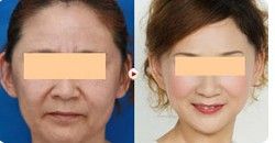 額頭除皺術 額頭除皺術