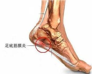 筋膜炎 筋膜炎