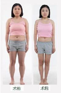 共振吸脂 共振吸脂