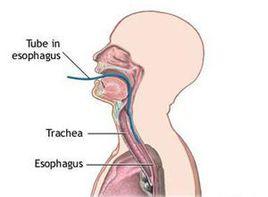 仰頸時吞咽困難 仰頸時吞咽困難