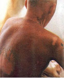 輻射中毒 輻射中毒