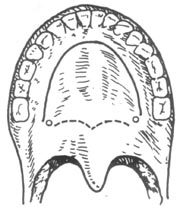 頸椎後縱韌帶骨化症