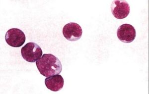 急性淋巴細胞性白血病