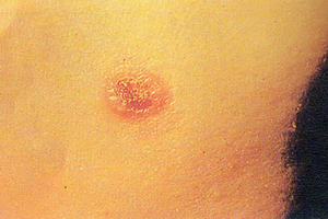 卡氏肺孢子蟲病