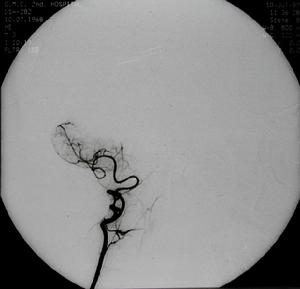 鎖骨下動脈盜血綜合徵