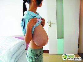 乳腺畸形 乳腺畸形