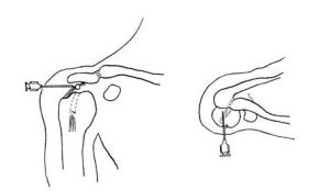 肩胛下間隙內封閉    　A．側方進針；B．前方進針