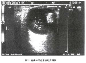 睫狀體黑色素瘤