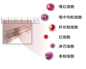 巨幼細胞性貧血