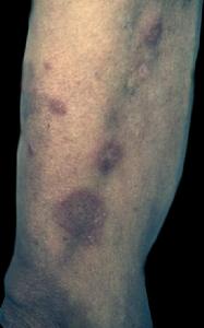 亞急性紅斑狼瘡 亞急性紅斑狼瘡