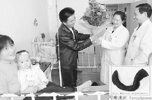 先天性弓形體感染