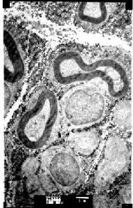 澱粉貯積病 澱粉貯積病