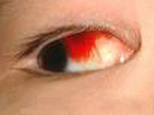 急性出血性結膜炎