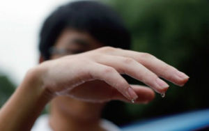 手腳多汗症 手腳多汗症