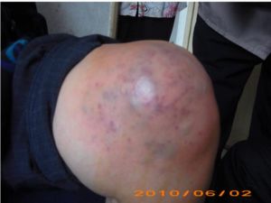 關節清理術 關節清理術