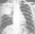 典型肺炎 典型肺炎