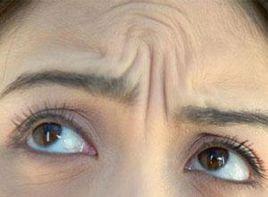 眉間皺紋 眉間皺紋