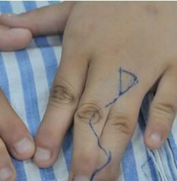 並指分開術 並指分開術