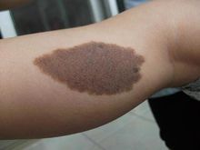 兩歲小孩腿上的咖啡斑