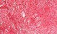 組織細胞纖維瘤
