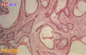 成釉細胞瘤 成釉細胞瘤