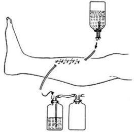 閉合灌洗、負壓引流術 閉合灌洗、負壓引流術