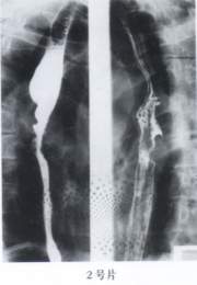 先天性食管狹窄
