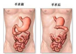 胃切除術 胃切除術