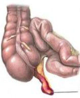 急性闌尾炎 急性闌尾炎