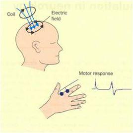 運動誘發電位 運動誘發電位