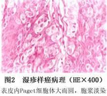 乳房外paget病 乳房外paget病
