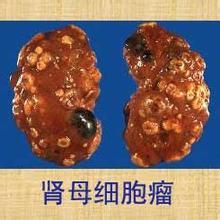腎母細胞瘤 腎母細胞瘤