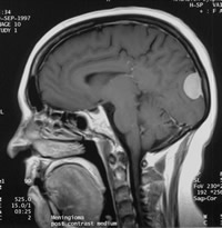 岩骨斜坡腦膜瘤