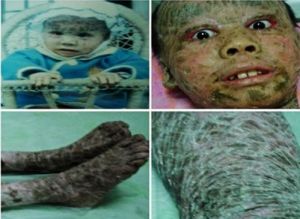 樹皮娃娃恐怖魚鱗病症