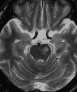 腦幹梗塞 腦幹梗塞