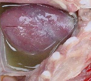 縮窄性心包炎 縮窄性心包炎