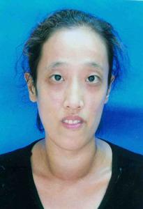 甲狀腺素毒性突眼