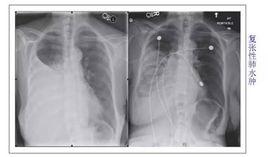 復張性肺水腫 復張性肺水腫