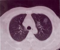 肺腺癌肺片